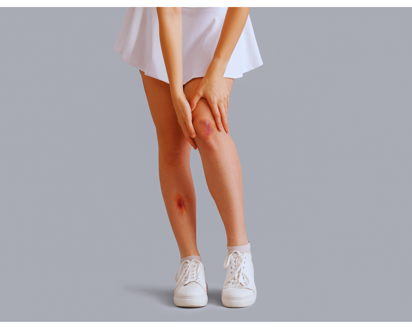 Bruise Balm